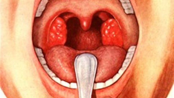 تعرف على أسباب وأعراض الحمى الروماتيزمية (فيديو)