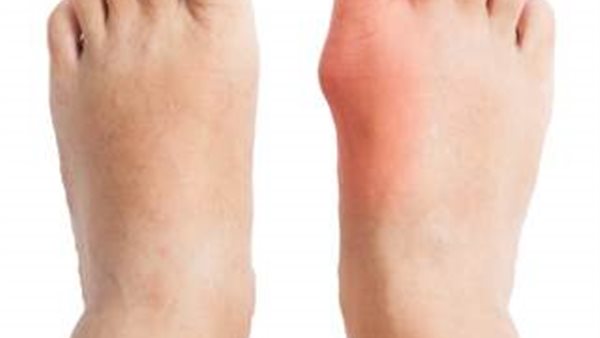 احذر..مأكولات تسبب «النقرس» (فيديو)