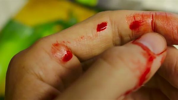 أسباب نزيف الدم بعد الإصابة .. «الدورة الدموية مواسير مقفولة» (فيديو)