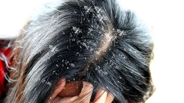 علاج قشرة الشعر (فيديو)