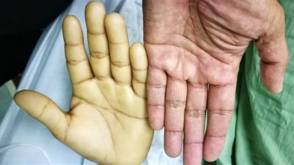  أعراض الأنيميا.. «شحوب وتغير في الأظافر»(فيديو)