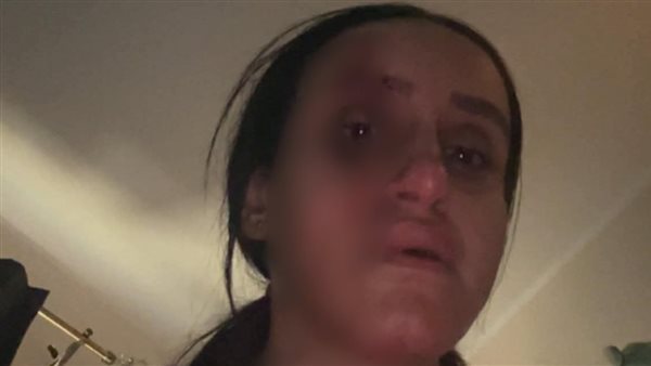  سحل وشرائح ومسامير.. ضحية زوجها بالبراجيل تكشف تفاصيل صادمة لـ17 سنة من العنف