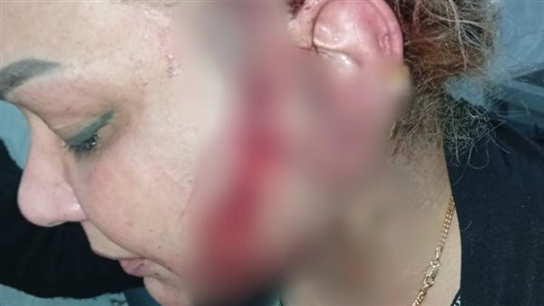تفاصيل القبض على المتهم بطعن طليقته في السيدة زينب بعد إصابتها بأكثر من 240 غرزة 