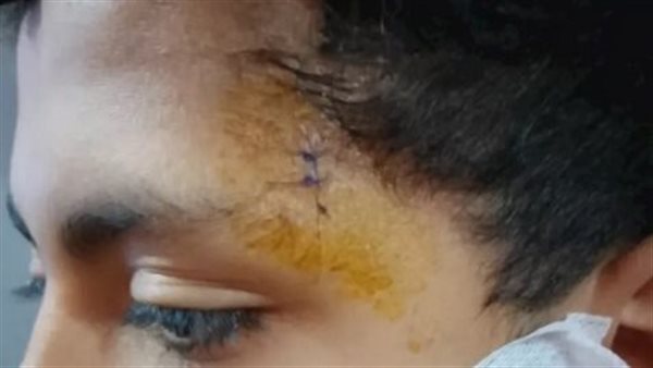 مأساة صلاة التراويح.. طفل الخانكة يشوه وجه آخر بكتر داخل مسجد 