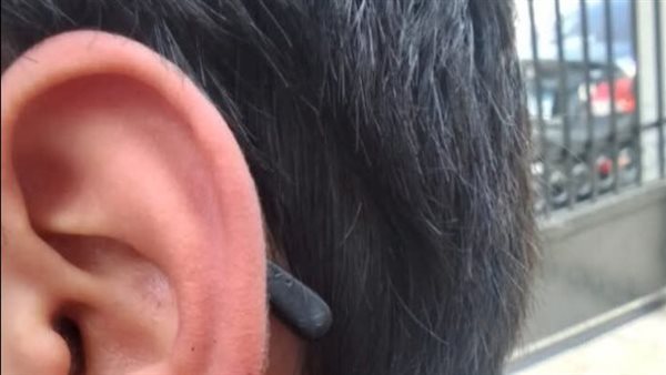 زميله عضه في الفصل.. طالب يفقد جزءًا من أذنه في مدرسة بالإسكندرية 