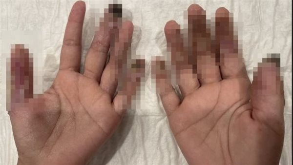 تفاصيل بتر عقلة إصبع بائعة بعد عضها من سيدة إريترية في الدقي