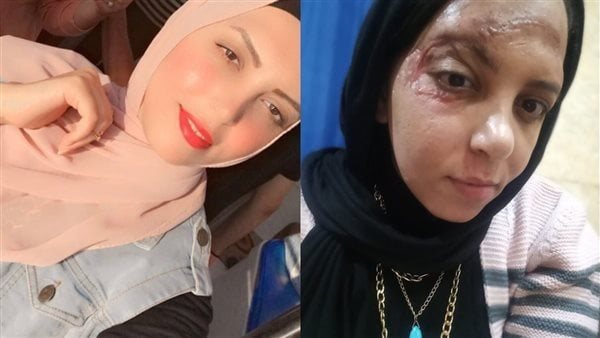 فتاة برج العرب ضحية الدهس تطالب بالقبض على المتهم وتنفيذ حكم حبسه
