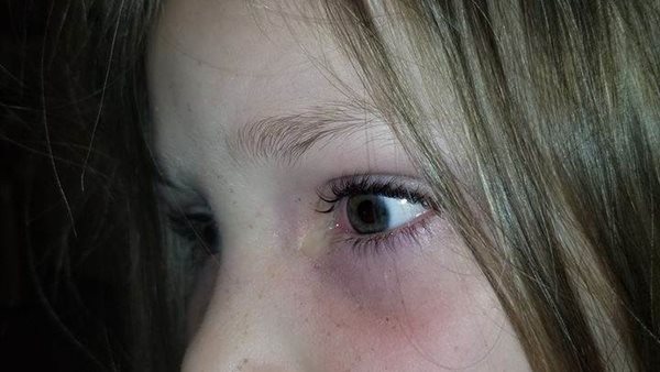 بالصور..خنفساء تسكن داخل عين طفلة لمدة 9 ساعات 