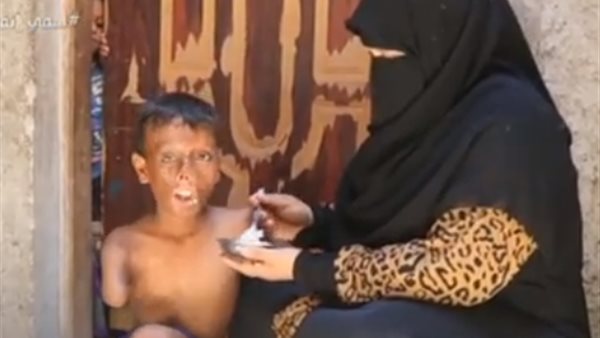 مأساة الطفل زياد.. «اشتعلت الدفاية فيه وأجرى 12جراحة» | فيديو