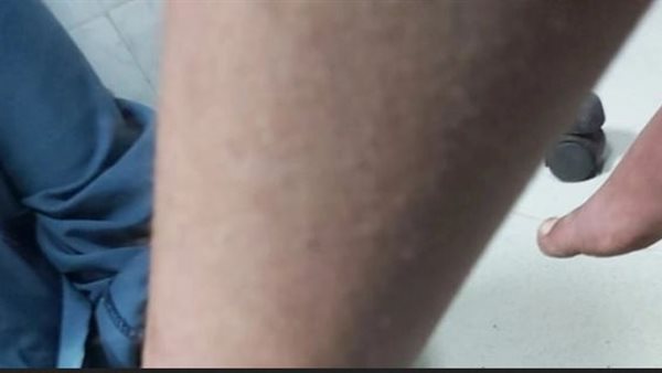 التفاصيل الكاملة لقيام ربة منزل وابنها بتعذيب الأب بماء ساخن