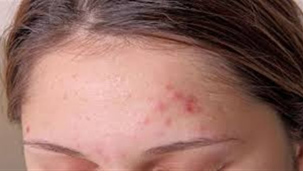 استشاري: حبوب الشباب قد تستمر لبعد الأربعين عامًا | فيديو