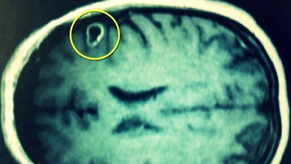 سمكة داخل الرئة وثعبان البحر في الأمعاء..أغرب 10 كائنات عاشت داخل جسم الإنسان | شاهد