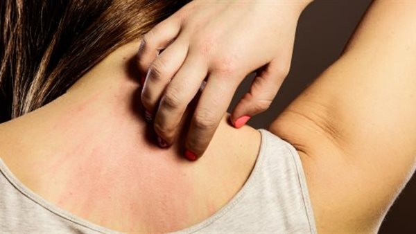 تعرف عليها..علامات جلدية جديدة تدل على الإصابة بفيروس كورونا