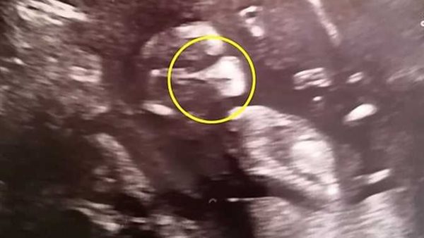 حامل مصابة بكورونا تنشر صورة جنينها يرتدي قناعًا للوجه.. ما القصة؟ | شاهد