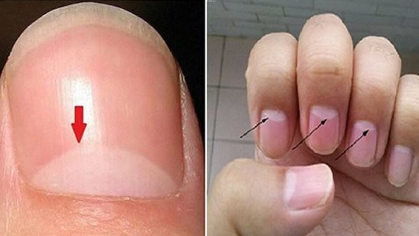 لن تتخيل أنه يدل على هذه الأمراض .. ماذا يعني وجود 