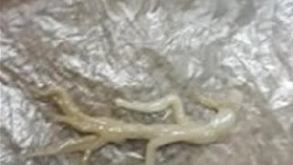 بعد شائعة خروج برص من فمه .. معجزة إلهية تنقذ رضيع المنوفية داخل مستشفى حكومي | شاهد