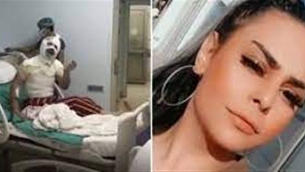 حرقها وعماها.. مراهقة تشوه وجهها وتفقد بصرها بعد هجوم حبيبها عليها