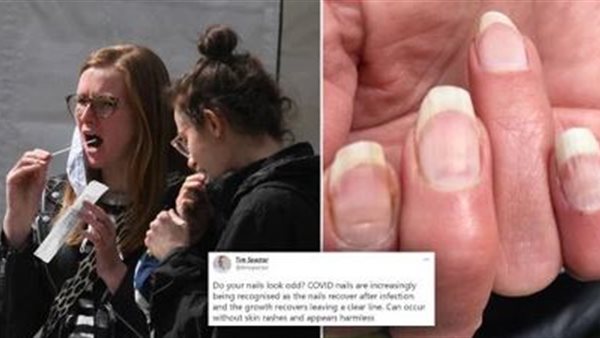 أظافر كورونا.. علامة هامة تدل على إصابتك بالفيروس من قبل | شاهد