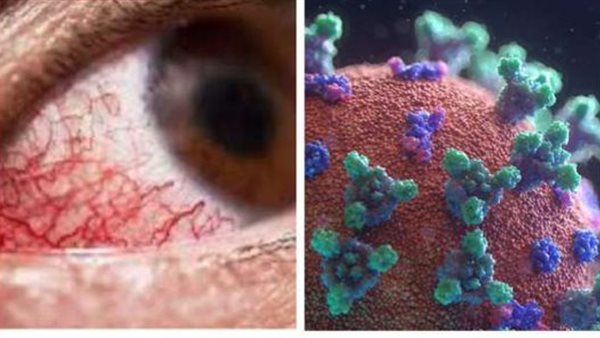 عاجل.. أول تعليق من الصحة على ظهور مرض الفطر الأسود في مصر