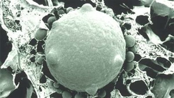 أخطر من الأسود ويشبه كورونا.. تفاصيل صادمة عن عدوى الفطر الأبيض