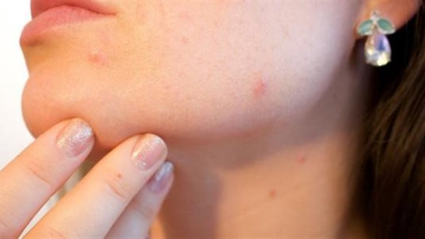 ما لا تعرفه عن جدري القرود..هل نحن على موعد مع وباء جديد يمحي البشرية؟