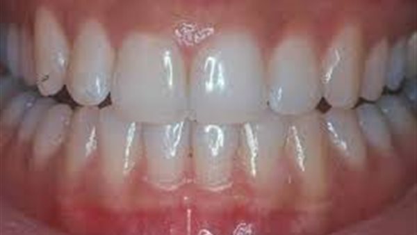 هذه أنواعها..كل ما تريد معرفته عن أمراض اللثة 