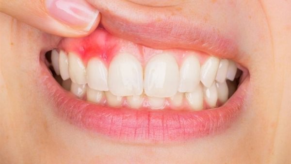 الوقاية خير من العلاج .. أسباب التهاب اللثة