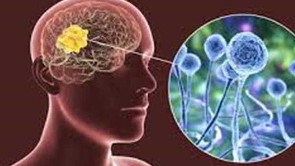 قد تكون مصابا دون أن تشعر..طبيب يكشف 4 علامات تدل على إصابتك بالفطر الأسود