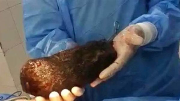 لن تصدق.. استخراج لُفافة شعر تزن 3 كيلو من معدة شاب في مطروح 