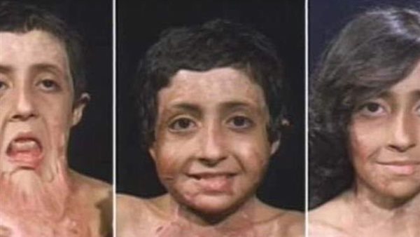 تخشى النظر في المرأة.. قصة مثيرة للفتاة ذات الوجه المنصهر