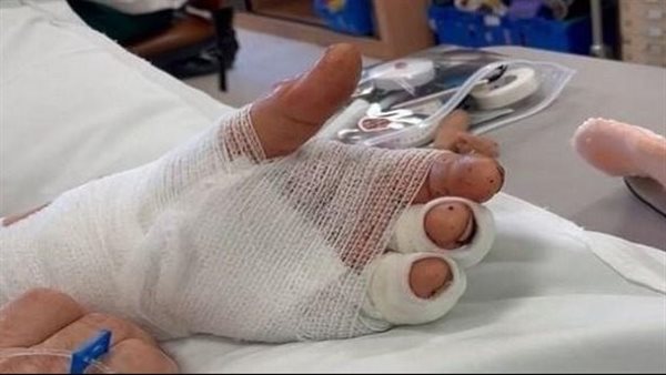 بعد أشهر من قطعها.. يد رجل تعود للحياة مرة أخرى