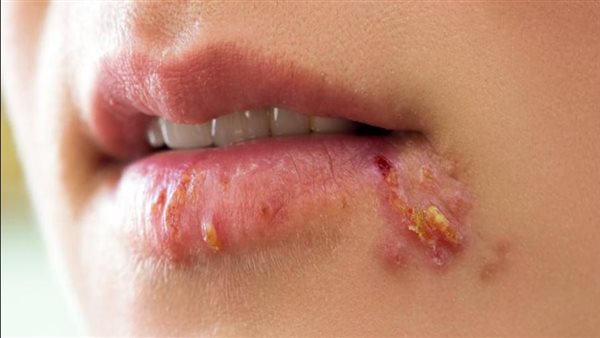 بعد ظهوره في الهند.. كل ما تريد معرفته عن الهربس