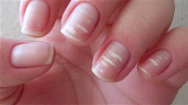 منها مرض القلب.. انتبه لظهور هذه البقع على الأظافر