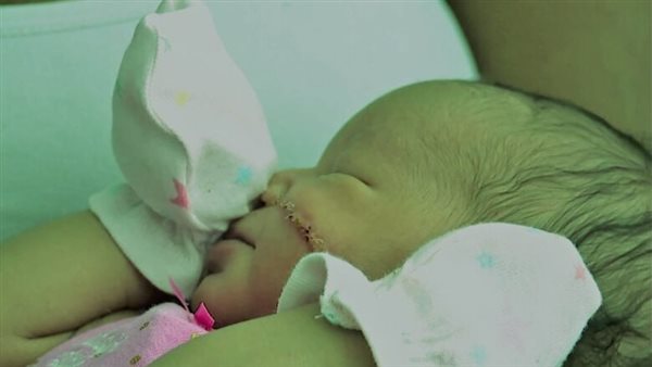 13 غرزة.. طبيب يتسبب في قطع بوجه مولودة أثناء ولادة قيصيرية| شاهد