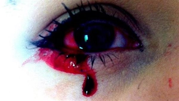 مش هتصدق عنيها بتنزل دم.. فتاة تستغيث : ساعدوني أعيش عيني وقعت وعندي 6 عيال