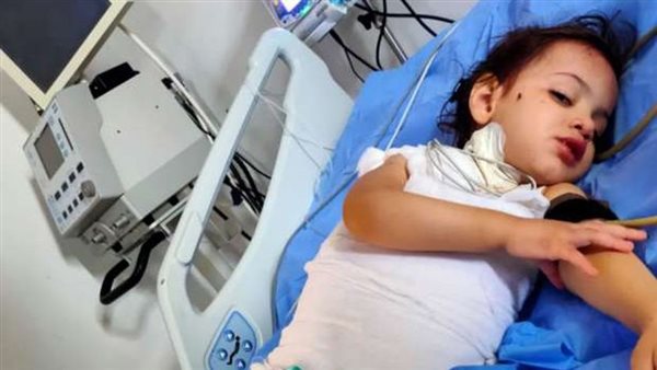 قلوب بلا رحمة.. عم وعمة يعذبون طفلة بيطفوا السجاير بجسمها