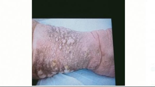 رجليها اتخرمت وبتنزل مياه سخنة.. فتاة تستغيث من مرض نادر