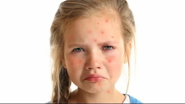 لمسة قاتلة من أخطر نبات.. إصابة طفلة بقروح وبثور مؤلمة 