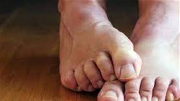 احذر..علامات في قدمك تشير لهذا المرض الخطير