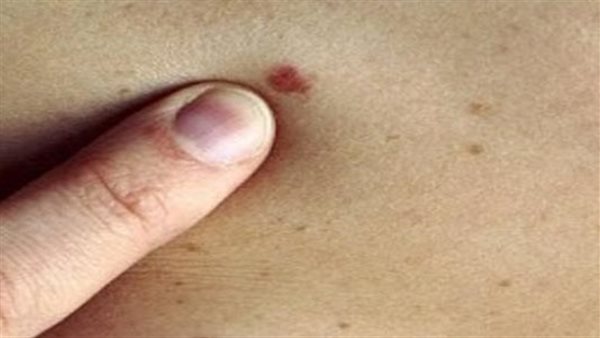 يظهر تحت إصبع القدم الكبير.. طبيب يكشف أسرار الإصابة بسرطان الجلد