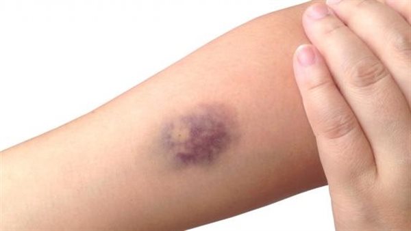 تعرف على سبب ظهور بقع زرقاء على الجسم..«زعل» ولا مرض خطير؟
