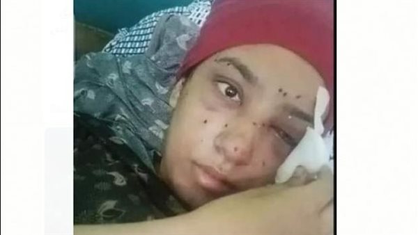 كانت بتدافع عن طفل.. فتاة تفقد عينها اليمنى بسبب خرطوش في خناقة