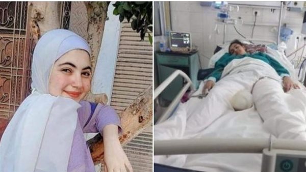  محتاجة جلد من ميت.. مأساة طفلة بين الحياة والموت بسبب «تريلا»
