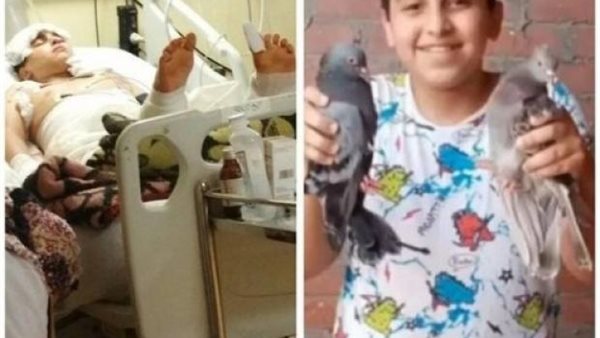 جسمه بيتقطع أنقذوه.. لعب عيال انتهى بحرق «أحمد» بالبنزين