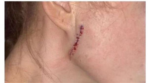 كريم بشرة «مضروب».. شوه وجه فتاة وكاد أن يقتلها