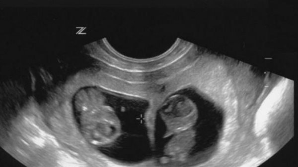 لإعطاء فرصة لاستمرار الحمل.. الإفتاء توضح مشروعية إجهاض عدد من الأجنة 