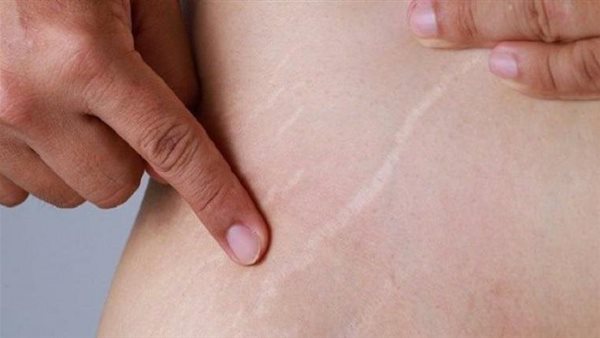 داعية ترد على سؤال فتاة: هل لازم خطيبي يعرف إن عندي «سترتش ماركس» بعد الرجيم؟