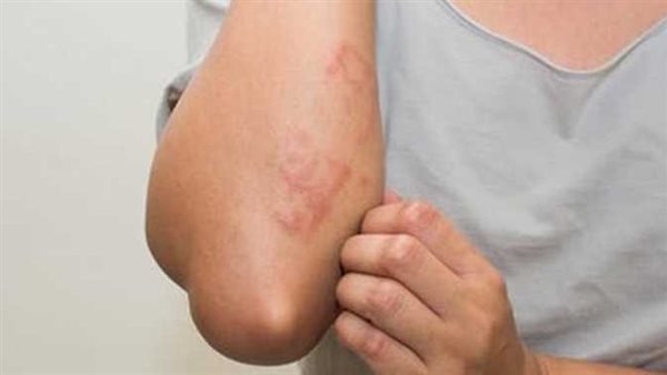 غير متوقعة.. 3 علامات جلدية تؤكد إصابتك بـ متحور أوميكرون