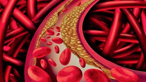 أحدها في العين.. علامات تشير إلى إصابتك بارتفاع الكوليسترول الوراثي