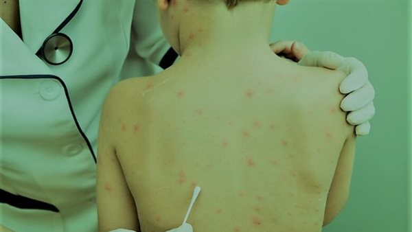 معدٍ بشكل كبير.. علامات الإصابة بـ جدري الماء وطرق علاجه